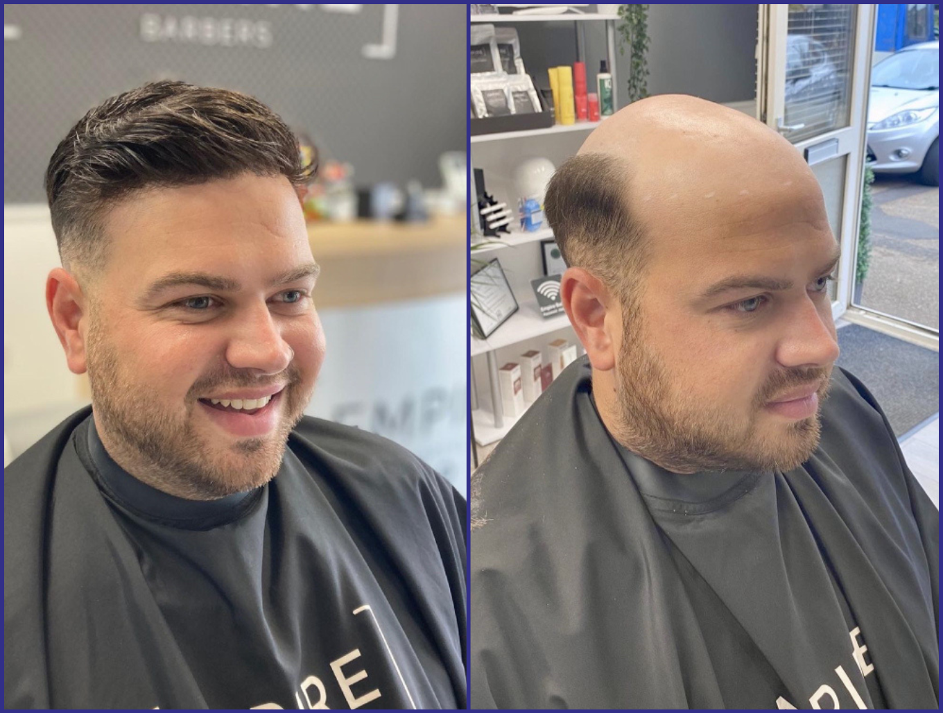 hair-replacement-before-after-kipling-sheffield-1.png